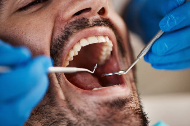 Best Chipped Tooth Repair Near Me  in Canton Valley, CT